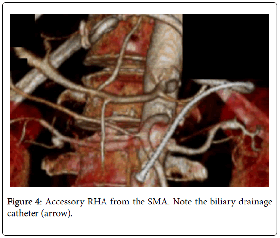 radiology-biliary-drainage
