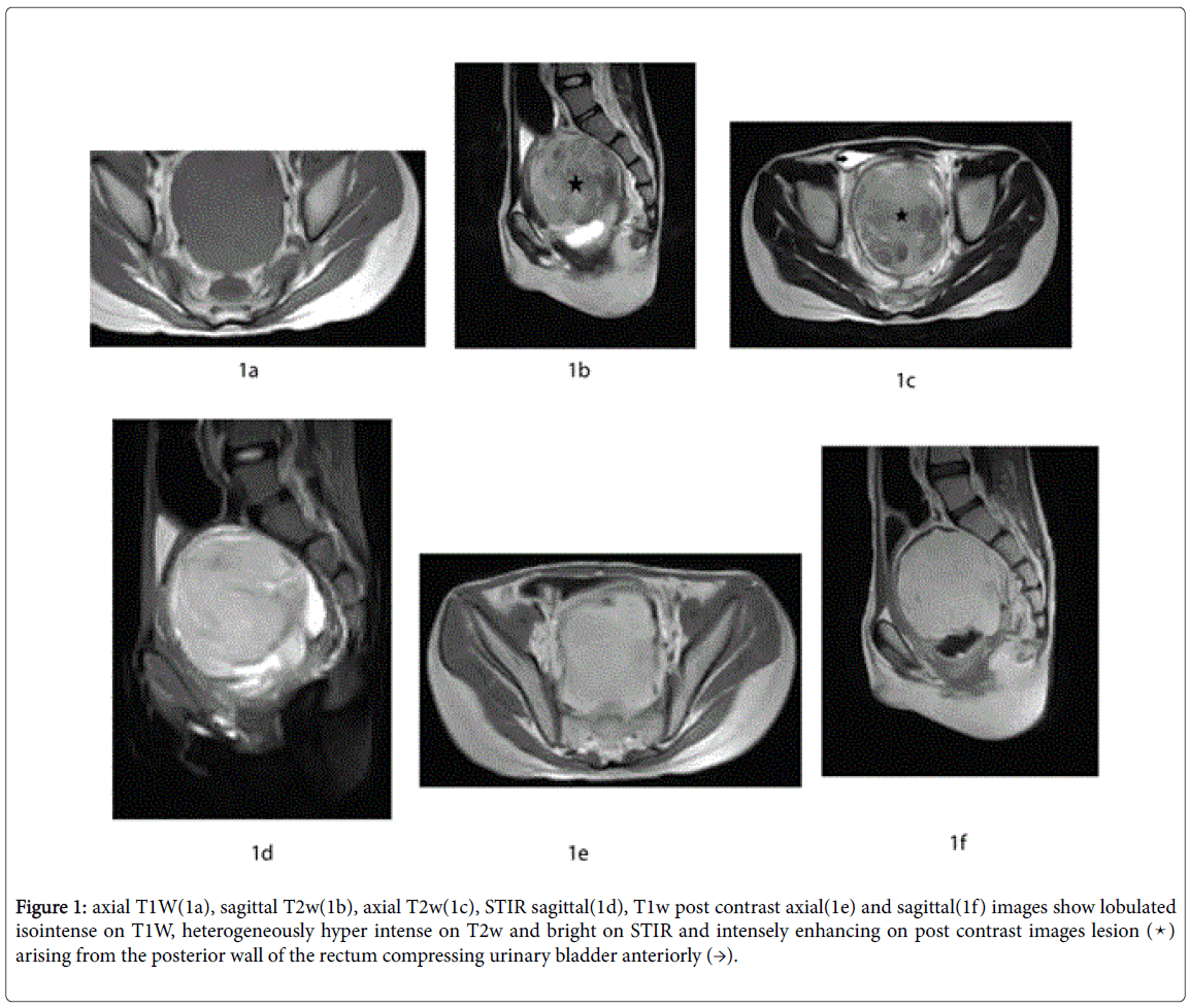 radiology-bladder-anteriorly