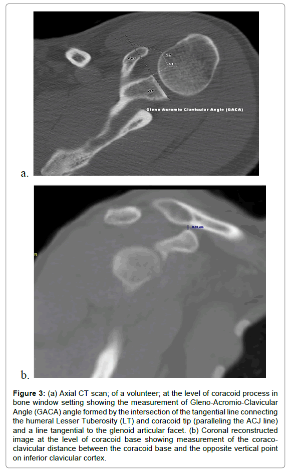 radiology-clavicular-cortex