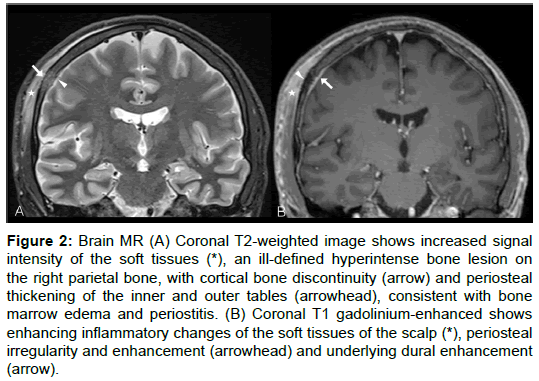 radiology-cortical-bone-discontinuity
