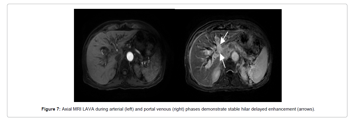 radiology-delayed-enhancement