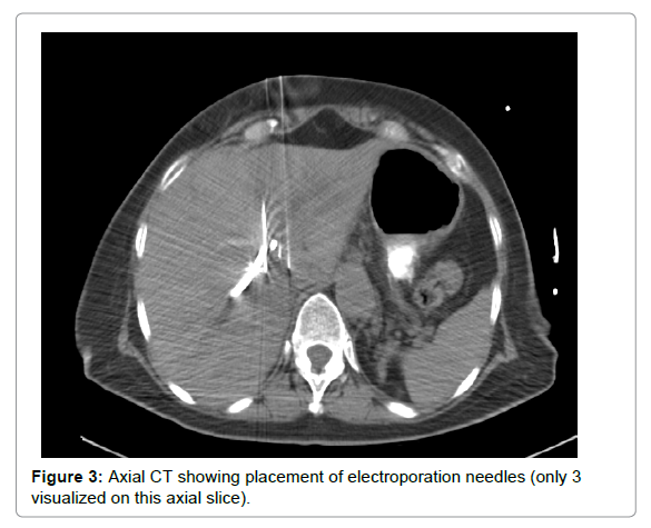 radiology-electroporation-needles
