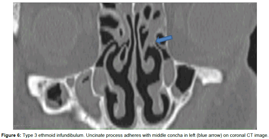 radiology-ethmoid-infundibulum