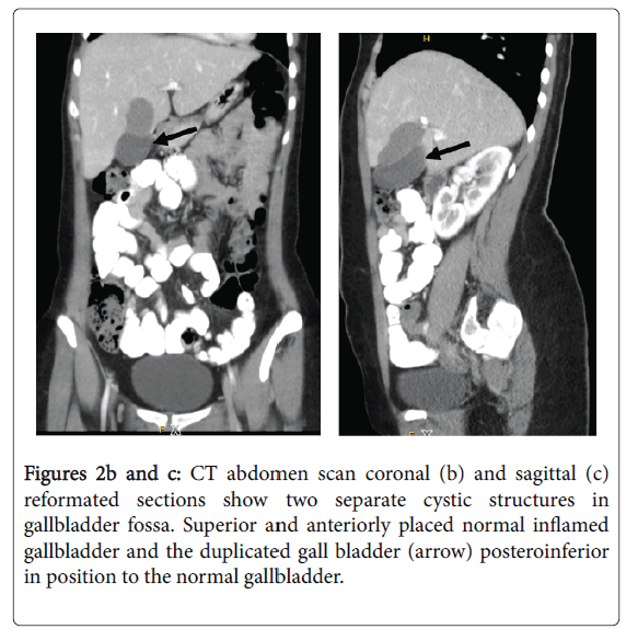 radiology-gallbladder-fossa