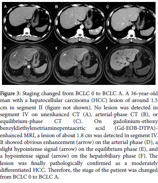 radiology-hepatocellular-carcinoma-gadolinium