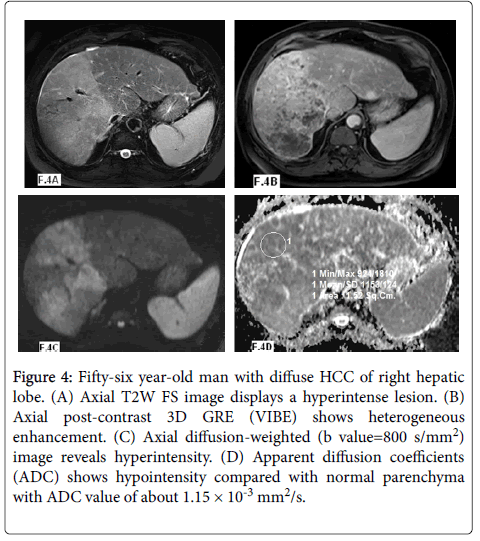 radiology-hyperintense-lesion