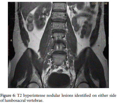 radiology-hyperintense-nodular