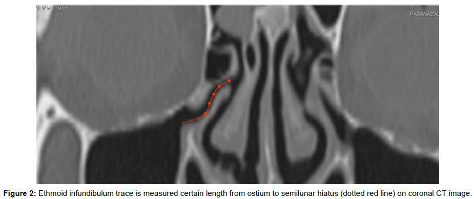 radiology-infundibulum-trace