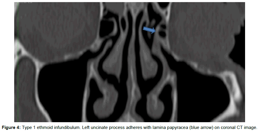 radiology-lamina-papyracea