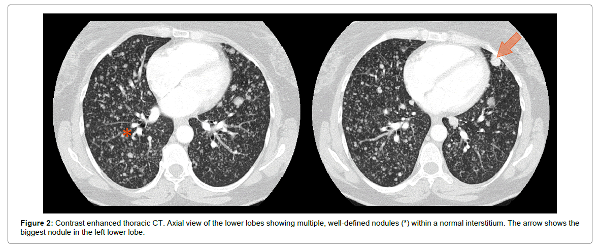 radiology-lower-lobe