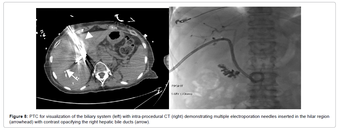 radiology-multiple-electroporation