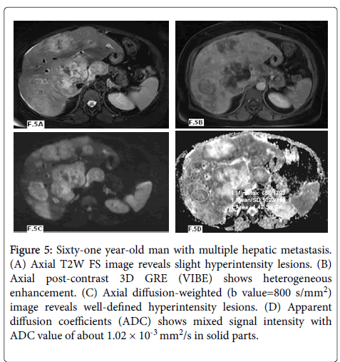 ADC values (mm2/s) of tumor and liver at different time points.