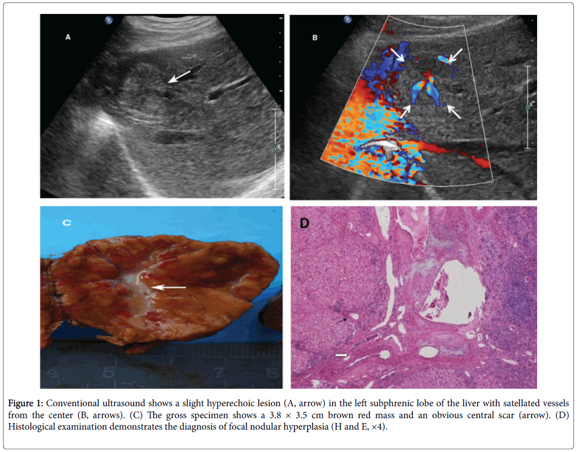 radiology-nodular-hyperplasia