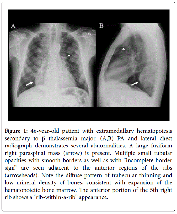 radiology-patient-extramedullary-hematopoiesis