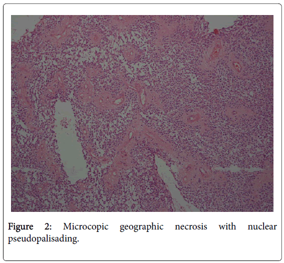 radiology-pseudopalisading
