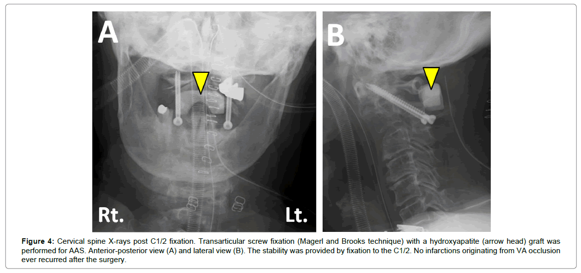 radiology-screw-fixation