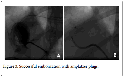 radiology-successful-embolization
