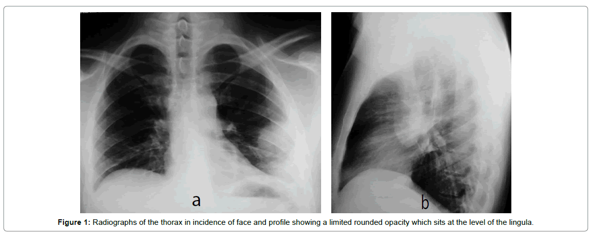 radiology-thorax-incidence