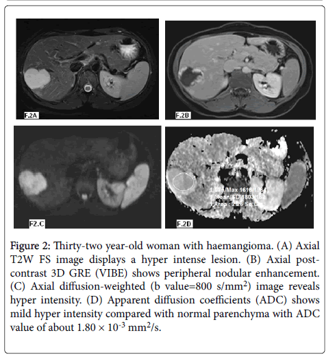 radiology-woman-haemangioma