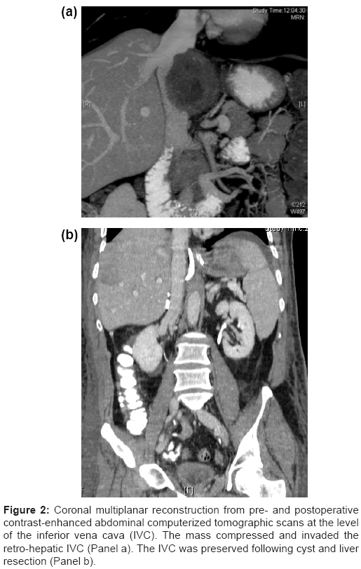 icd 10 code for left abdominal wall lipoma