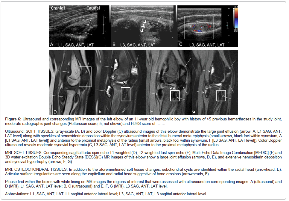 icd 10 code for hematoma of right iliopsoas muscle