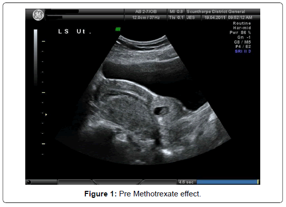 Methotrexate Side Effects Pregnancy