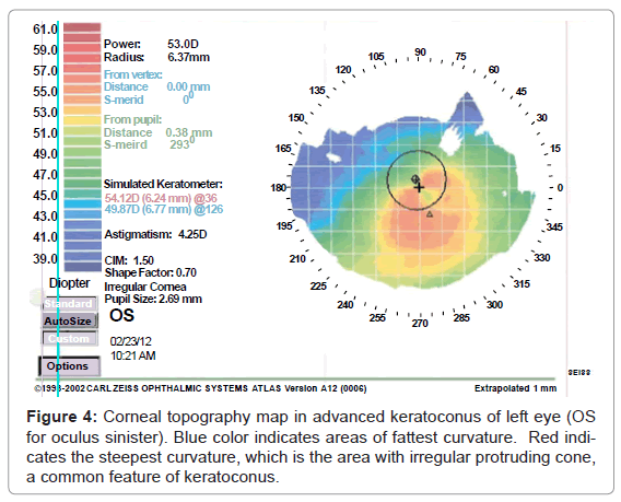 the genetics of keratoconus a review omics international sexual disorders irregular protruding cone