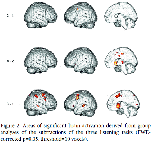 speech-pathology-therapy-Areas-of-significant-brain