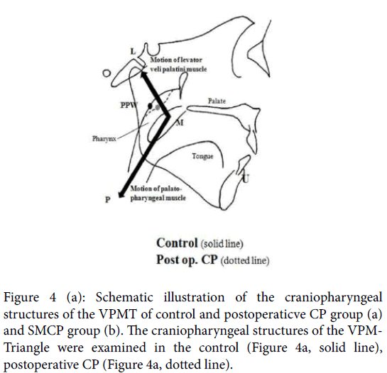 speech-pathology-therapy-craniopharyngeal-structures