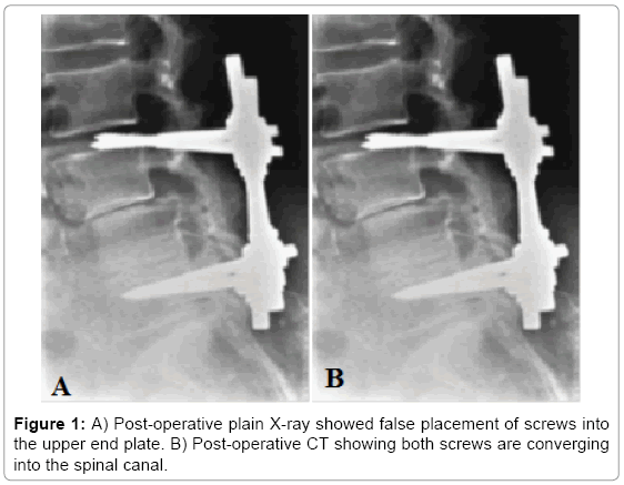 L5-s1 pseudarthrosis radiology image