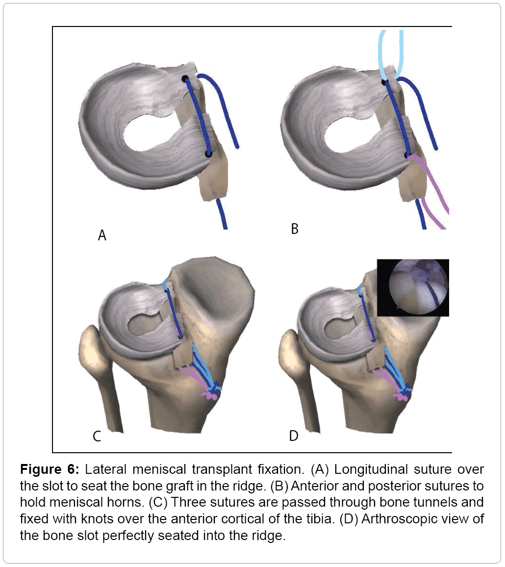 Meniscal Transplantation