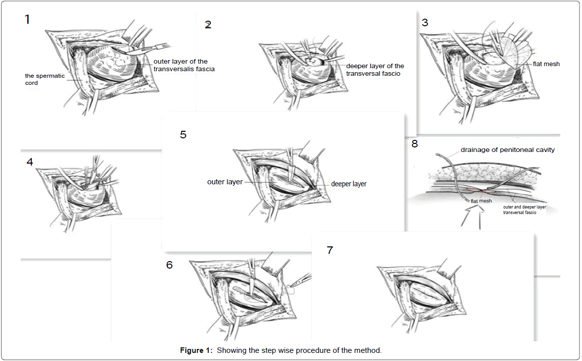 herniorrhaphy
