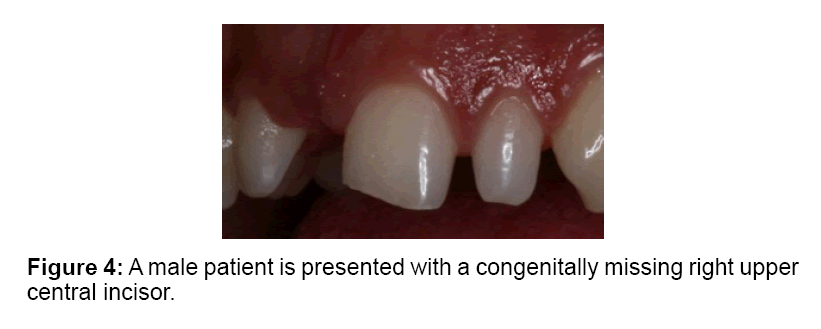 replacing congenitally missing central incisor a case report with a central incisor
