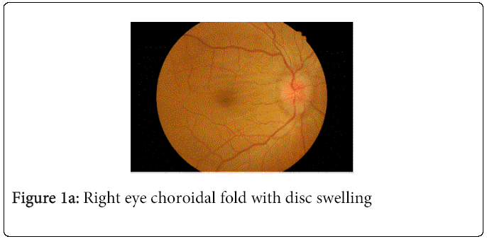 Surgery Current Research Choroidal Surgery Current Research Choroidal
