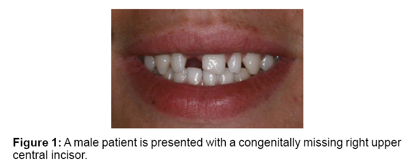 replacing congenitally missing central incisor a case report with a central incisor