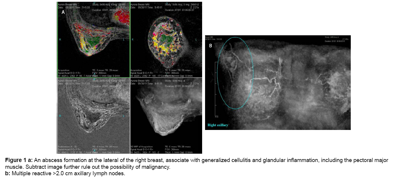 left breast cellulitis icd 10 code
