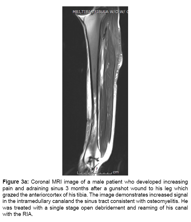 The ReamerIrrigatorAspirator Roles and Evidence Supporting its use