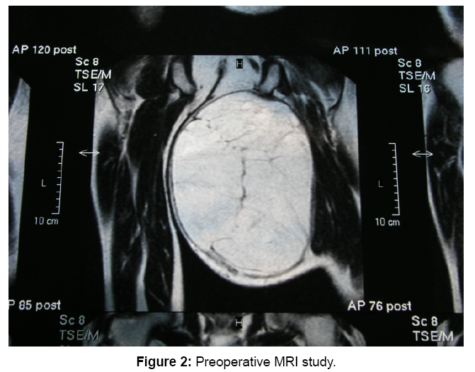 Giant Mixed Lipomaliposarcoma Of The Thigh Diagnostic Approaches And