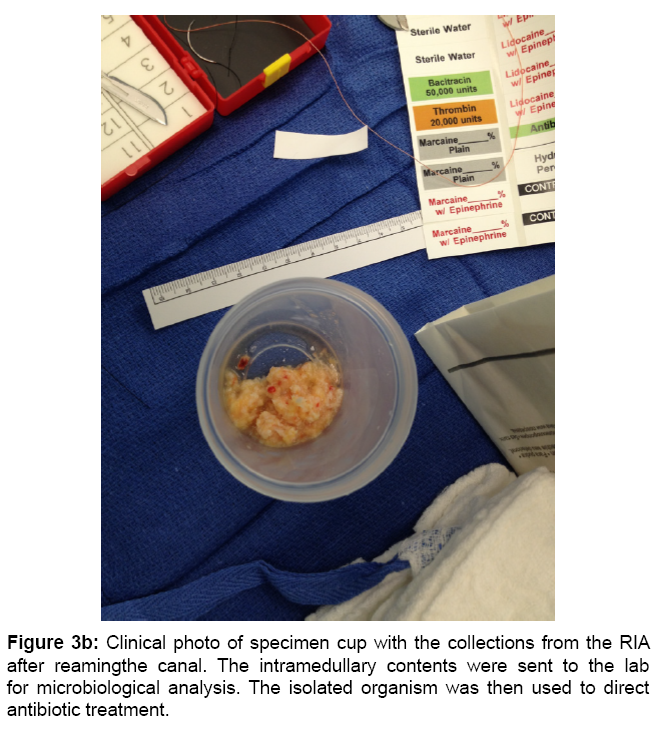 The ReamerIrrigatorAspirator Roles and Evidence Supporting its use
