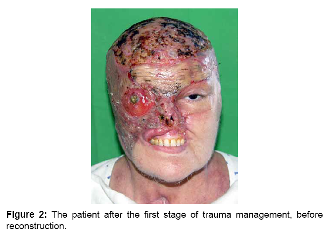 Doubt facial trauma reconstruction Facial trauma reconstruction opinion you