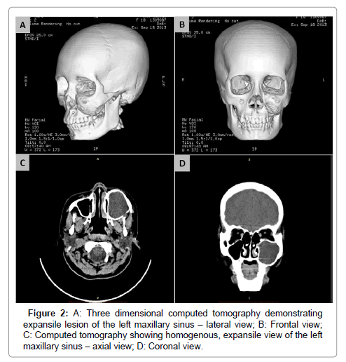 obstructive mucocele of the maxillary sinus in an 18 year old maxillary sinus