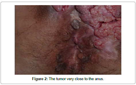 Bi cuckold interracial Condyloma accuminatum on the anus