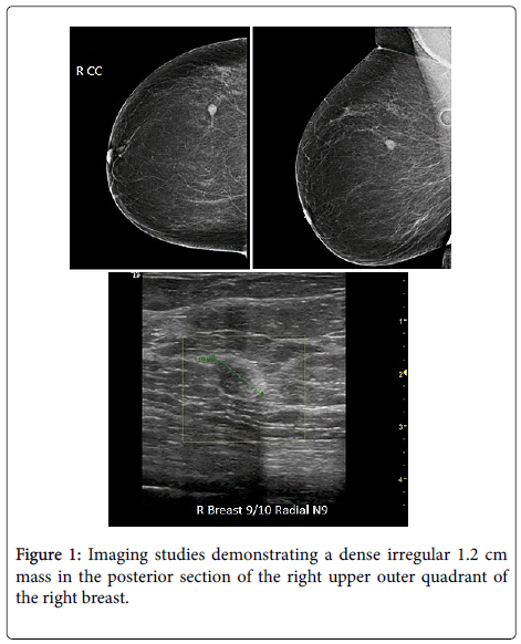 Surgical Oncology Dense Irregular Surgical Oncology Dense Irregular