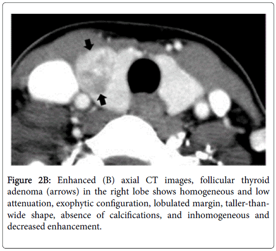 Computed Tomography Features of Follicular Thyroid Adenoma and