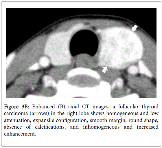 Computed Tomography Features of Follicular Thyroid Adenoma and
