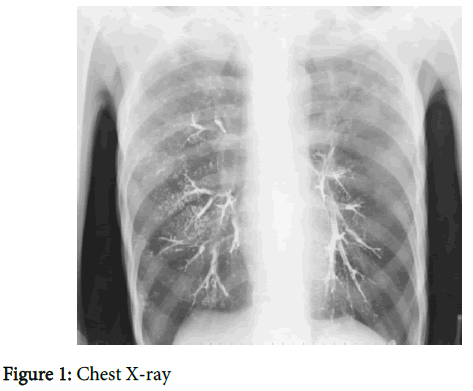 aspiration of barium sulfate during an upper gastrointestinal