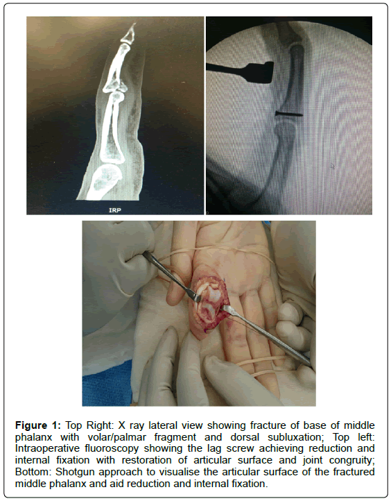 transplant-reports-lateral-fracture-phalanx