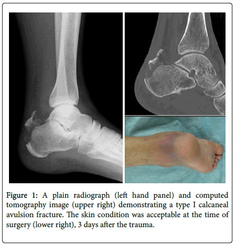 a novel technique for calcaneal avulsion fracture a case report calcaneal fracture