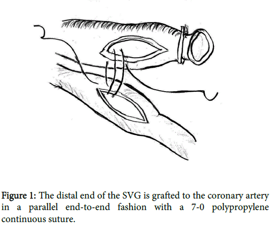 coronary artery bypass grafting using side to side anastomosis with