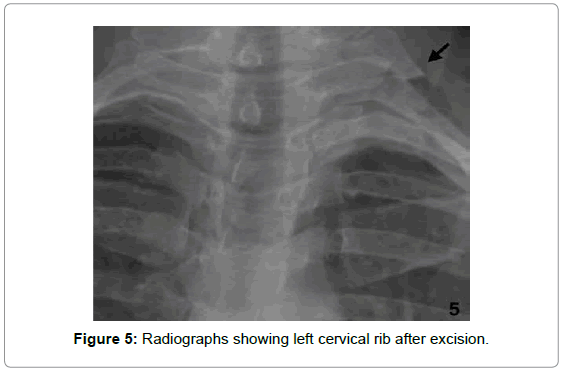 cervical rib causing occlusion of the subclavian artery and thoracic